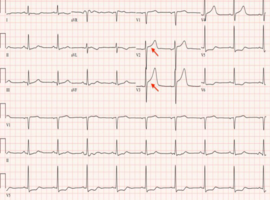 Resurrecting the Heart: Complex Coronary Reconstruction on Central VA ECMO for Immediate Post-CABG STEMI
