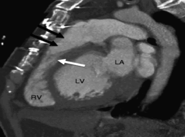 Right Ventricular Outflow Tract PVCs and Long QT in a 22-Year-Old Female with COVID-19 and Concomitant Nirmatrelvir-Ritonavir and Fluoxetine Use