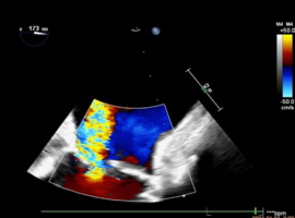 Transesophageal Echocardiography-Guided Management of Acute Left Main Coronary Thromboembolism During Redo Aortic Valve Surgery