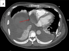 Right Atrial Metastasis from Hepatocellular Carcinoma Leading to Submassive Pulmonary Embolism: An Uncommon Clinical Presentation