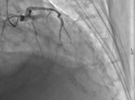 Right Coronary Artery Post-stenotic Giant Saccular Aneurysm that is Managed by Graft Stenting after Revascularization of Aneurysmatic Lad Lesion for Acute Anterior STEMI