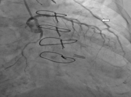 Positional Coronary Subclavian Steal Syndrome from Thoracic Outlet Compression