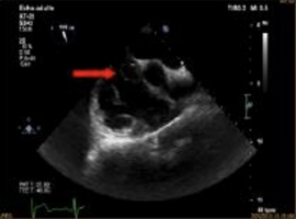 A Case of Highly Developed Chiari Network Mimicking a Right Atrial Thrombus