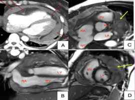 A Complex Pericardial Effusion and Diagnostic Dilemma: A Case of Primary Pericardial Angiosarcoma