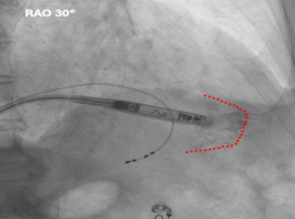 Early Dislodgement and Iliac Vein Embolization of a Ventricular Leadless Pacemaker: A Case Report