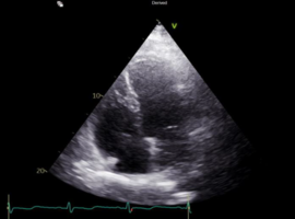 A Rare Case of Takotsubo Cardiomyopathy in a 51-year-old Male Patient
