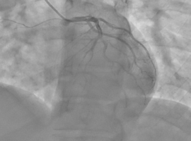 Spontaneous Coronary Artery Dissection: Review of Current Management Strategies