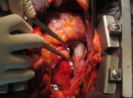 Successful R0 Resection of Right Atrial Metastasis in a Patient with Cervical CUP Syndrome
