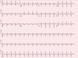 Unmasking of Brugada Syndrome Type 1 from Lithium Administration