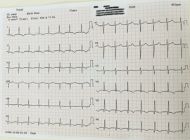 Anomalous Left Coronary Artery from the Pulmonary Artery Presenting as Acute Respiratory Distress after Feeding in a 3-Month-Old Infant: A Case Report