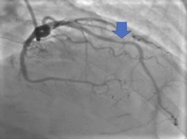A Bridge Too Far: A Case of Myocardial Bridge Requiring Unroofing and Complicated by Post-Cardiac Injury Syndrome