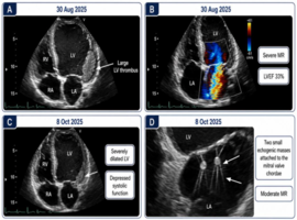 Cortical Laminar Necrosis Following ALCAPA Repair Complicated by Intracardiac Thrombus: A Pediatric Postoperative Educational Clinical Scenario