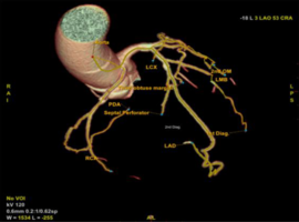 Coexistence of Anomalous Right Coronary Artery Originating from the Left Coronary Cusp and Interventricular Membranous Septal Aneurysm: A Rare Dual Congenital Findings