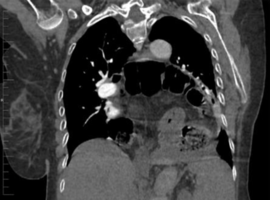 The Unexpected Squeeze: When a Hiatus Hernia Induces Cardiac Tamponade and Causes a Myocardial Infarction