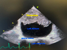 Giant Left Atrial Mural Thrombus: Successful Conservative Management with Warfarin: A Case Report Emphasizing Reduced Mortality Compared to Early Surgical Reintervention