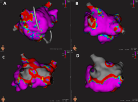 Pulmonary Vein Isolation and Concomitant Posterior Wall Box Isolation with Pulsed Field Ablation Using a Right Transjugular Access in a Patient with Long-Standing Persistent Atrial Fibrillation