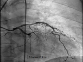 A Rare Case of ST Elevation with Complete Occlusion of the Left Circumflex Artery in the Setting of Anaphylactic Shock: A Case Report