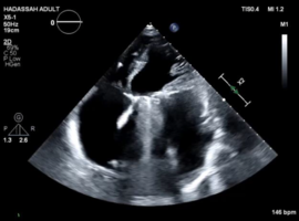 Mechanical Mitral Valve Failure after 40 Years: A Case Study in Timing and Decision-Making