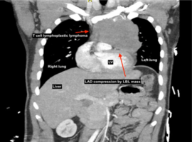 Adult T-type Lymphoblastic Lymphoma Presenting as Inferior Wall Myocardial Infarction: A Case Report