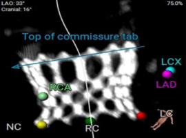 ViViV TAVR for Severe Symptomatic Aortic Stenosis in a Degenerated Prior TAVR ViV: A Case Report
