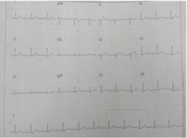 Cardiac Abnormalities in Old Patient with Dengue Fever: A Case Report